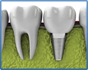 Implant Dentistry Meriden CT